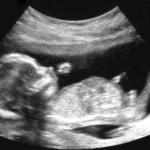 14. hafta gebelik bebek ultrason grafiği